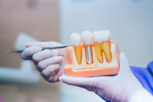 Dentist with tooth implant false teeth. Dentistry and healthcare