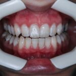 Albirea dentară profesională: Ce trebuie să știi înainte