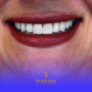 igienaoralasiintretinereriscuriimplantdentar_wp